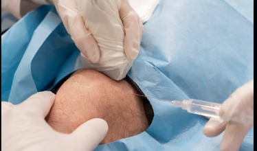 Advanced Knee Pain Treatment Without Surgery: Introducing Arthrosamid&reg;